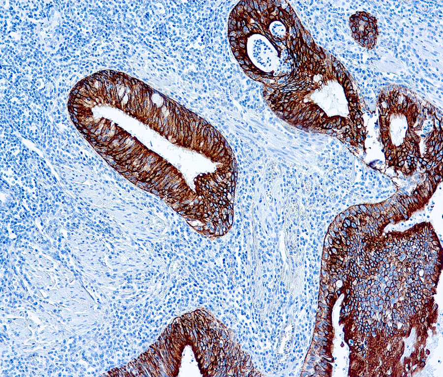 Mouse Monoclonal Antibody to Cytokeratin AE1/AE3(Clone: AE1+AE3)(Discontinued)