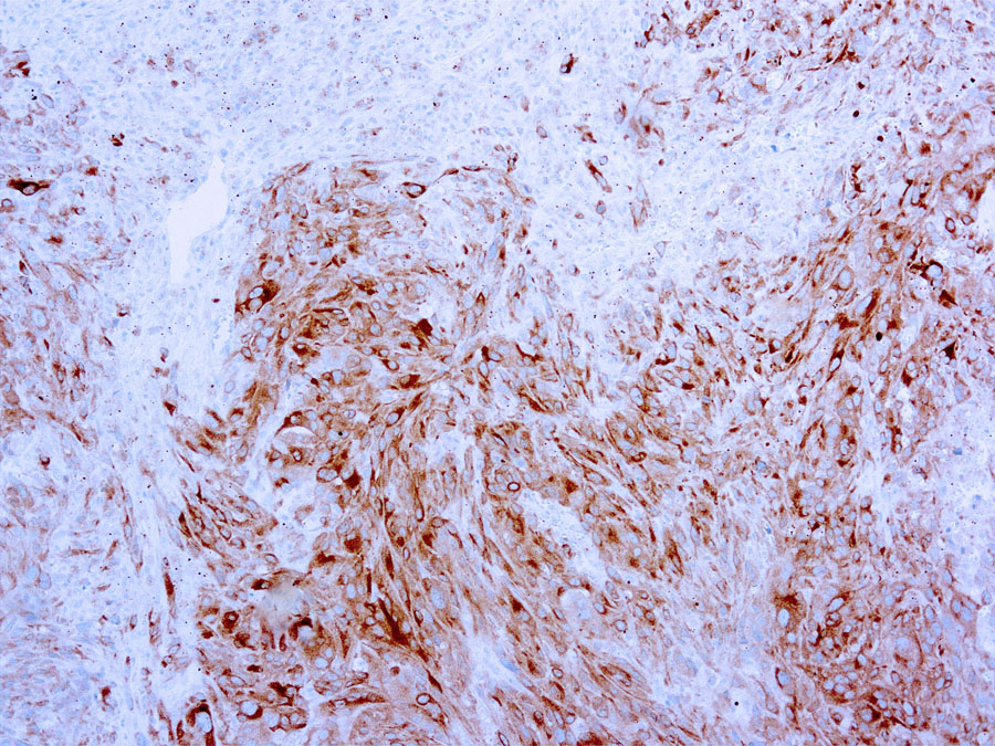 Mouse Monoclonal Antibody to MART-1/Melan-A, Melanoma Marker(Clone: A103)(Discontinued)