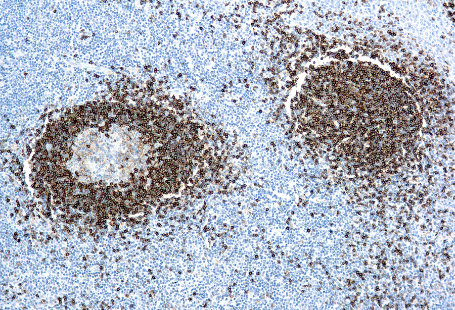 Mouse Monoclonal Antibody to Hairy Cell Leukemia(Clone: DBA.44)(Discontinued)