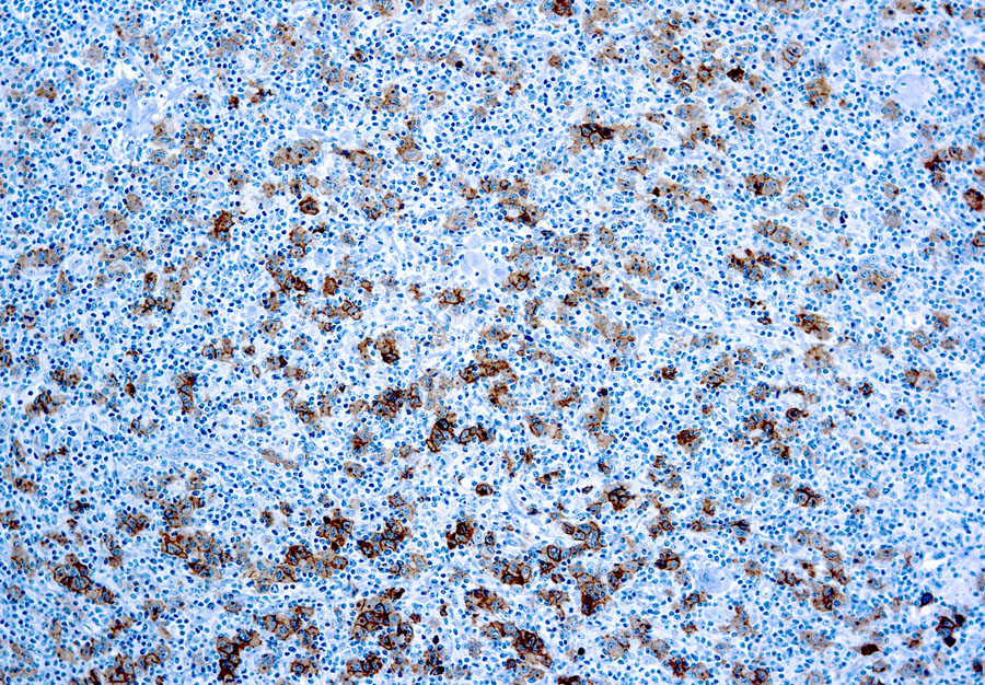 Mouse Monoclonal Antibody to CD30(Clone: Ber-H2)(Discontinued)