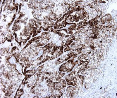 Mouse Monoclonal Antibody to Pan Cytokeratin(Clone :BS5)