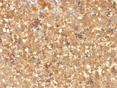 Monoclonal Antibody to AFP (Alpha Fetoprotein) (Hepatocellular/Germ Cell Tumor Marker)(Clone : MBS-12)