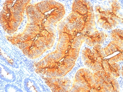 Monoclonal Antibody to TAG-72 / CA72.4 (Tumor-Associated Glycoprotein)(Clone : SPM148)