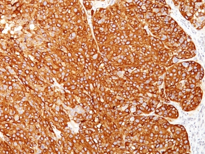 Monoclonal Antibody to Melanoma Marker (MART-1 + gp100 + Tyrosinase)(M2-7C10 + M2-9E3 + HMB45 + T311)