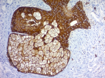 Monoclonal Antibody to Cytokeratin, pan (Epithelial Marker)(Clone : PAN-CK (Cocktail)