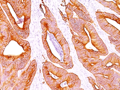 Monoclonal Antibody to Cytokeratin, pan (Epithelial Marker)(Clone : AE-1/AE-3)(Discontinued)