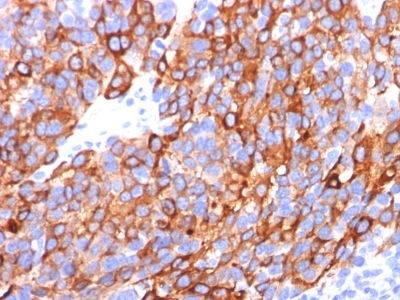 Monoclonal Antibody to MART-1 / Melan-A / MLANA (Melanoma Marker)(A103 + M2-7C10 + M2-9E3)