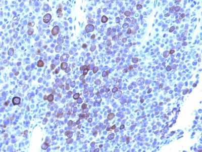 Monoclonal Antibody to Glypican-3 (GPC3) (Hepatocellular Carcinoma Marker)(1G12 + GPC3/863)