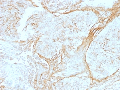 Monoclonal Antibody to Tenascin C (Stromal Marker For Epithelial Malignancy)(Clone : SPM319)