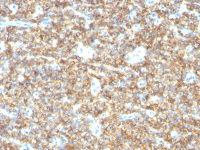 Monoclonal Antibody to CD99 / MIC2 (Ewing's Sarcoma Marker)(Clone : HO36-1.1)