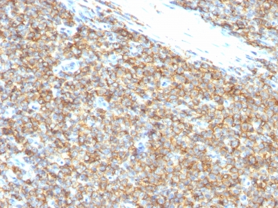 Monoclonal Antibody to CD99 / MIC2 (Ewings Sarcoma Marker)(12E7.)