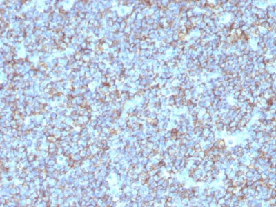 Monoclonal Antibody to CD99 / MIC2 (Ewing's Sarcoma Marker)(Clone : SPM596)