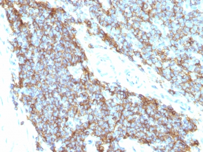 Monoclonal Antibody to CD99 / MIC2 (Ewing's Sarcoma Marker)(12E7 + MIC2/877)