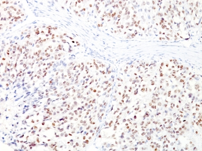 Monoclonal Antibody to Microphthalmia Transcription Factor (MITF)(D5 + MITF/915)