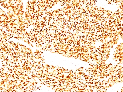 Monoclonal Antibody to MyoD1 (Rhabdomyosarcoma Marker)(Clone : SPM427)