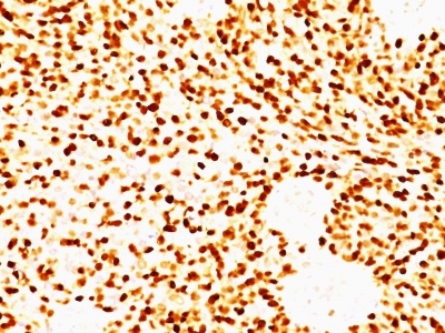 Monoclonal Antibody to MyoD1 (Rhabdomyosarcoma Marker)(Clone : MYD712)(Discontinued)