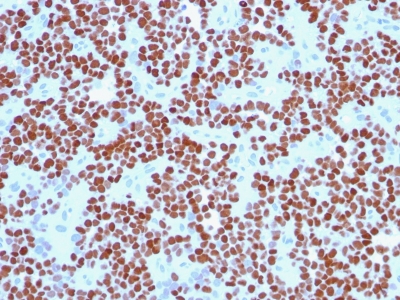 Monoclonal Antibody to NKX2.2 (Neuroendocrine & Ewing's Sarcoma Marker)(Clone : NX2/294)