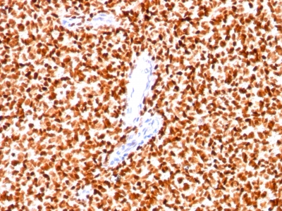 Monoclonal Antibody to NKX2.2 (Neuroendocrine & Ewing Sarcoma Marker)(Clone : SPM564)