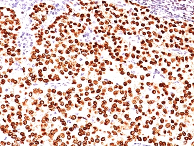 Monoclonal Antibody to Progesterone Receptor (Marker of Progestin Dependence)(Clone : SPM566)