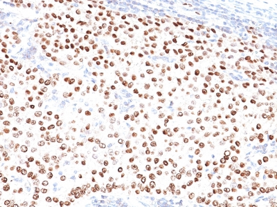 Monoclonal Antibody to Progesterone Receptor (Marker of Progestin Dependence)(Clone : PR500)