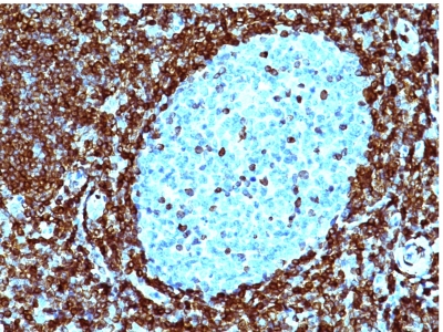 Monoclonal Antibody to Bcl-2 (Apoptosis & Follicular Lymphoma Marker)(Clone : 124)