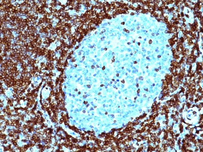 Monoclonal Antibody to Bcl-2 (Apoptosis & Follicular Lymphoma Marker)(Clone : SPM530)