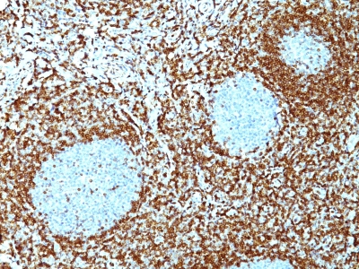 Monoclonal Antibody to Bcl-2 (Apoptosis & Follicular Lymphoma Marker)(100/D5 + 124)