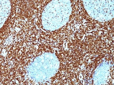 Monoclonal Antibody to Bcl-2 (Apoptosis & Follicular Lymphoma Marker)(BCL2/782 + BCL2/796)