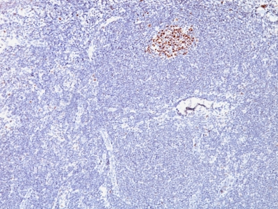 Monoclonal Antibody to Bcl-6 (Follicular Lymphoma Marker)(Clone : SPM602)(Discontinued)