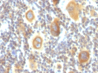 Monoclonal Antibody to Bcl-6 (Follicular Lymphoma Marker)(Clone : PG-B6P)(Discontinued)(Discontinued)