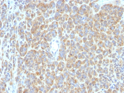 Monoclonal Antibody to Bcl-6 (Follicular Lymphoma Marker)(Clone : SPM363)(Discontinued)(Discontinued)