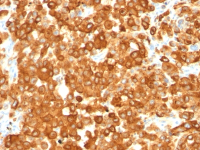 Monoclonal Antibody to gp100 / Melanosome / PMEL17 / SILV (Melanoma Marker)(Clone : HMB45)