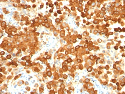 Monoclonal Antibody to gp100 / Melanosome / PMEL17 / SILV (Melanoma Marker)(HMB45 + PMEL/783)