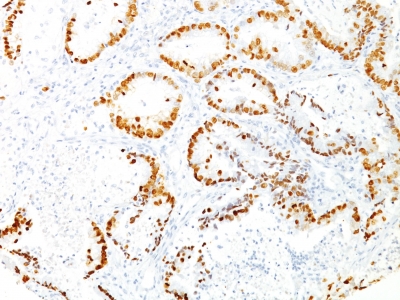 Monoclonal Antibody to TTF-1 / NKX2.1 (Thyroid & Lung Epithelial Marker)(Clone : 8G7G3/1)