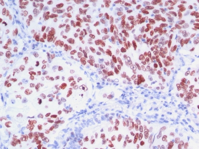 Monoclonal Antibody to TTF-1 / NKX2.1 (Thyroid & Lung Epithelial Marker)(8G7G3/1 + NX2.1/690)