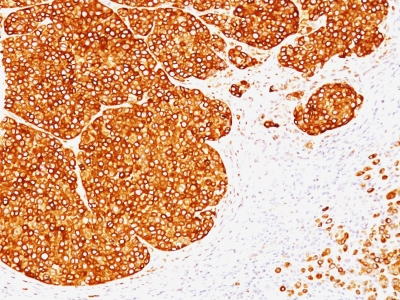 Monoclonal Antibody to Tyrosinase (Melanoma Marker)(Clone : SPM360)