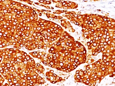 Monoclonal Antibody to Tyrosinase (Melanoma Marker)(T311 + OCA1/812)