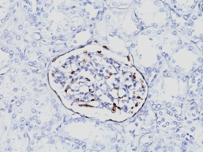 Monoclonal Antibody to Wilm's Tumor 1 (WT1) (Wilm's Tumor & Mesothelial Marker)(Clone : 6F-H2)