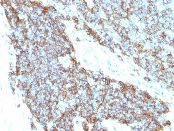 Anti-CD99 / MIC2 (Ewing's Sarcoma Marker) Monoclonal Antibody(Clone: 12E7 + MIC2/877)