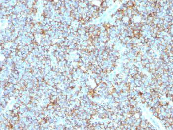 Anti-CD99 / MIC2 (Ewing's Sarcoma Marker) Monoclonal Antibody(Clone: MIC2/1495R)