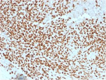 Anti-NKX2.2 (Neuroendocrine & Ewing's Sarcoma Marker) Monoclonal Antibody(Clone: NX2/1523)