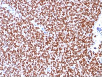 Anti-NKX2.2 (Neuroendocrine & Ewing's Sarcoma Marker) Monoclonal Antibody(Clone: rNX2/294)