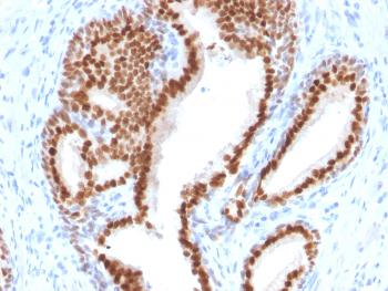 Anti-NKX3.1 (Metastatic Prostate Adenocarcinoma Marker) Monoclonal Antibody(Clone: NKX3.1/2576)