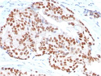 Anti-NKX3.1 (Metastatic Prostate Adenocarcinoma Marker) Monoclonal Antibody(Clone: NKX3.1/3347)