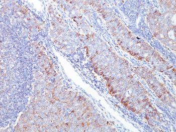 Anti-GLUT-1 (Tumor Progression and Mesothelioma Marker) Monoclonal Antibody(Clone: GLUT1/2476)