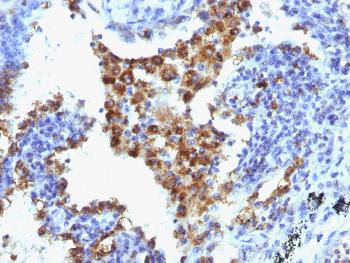 Anti-Napsin A (Lung Adenocarcinoma Marker) Monoclonal Antibody(Clone: NAPSA/1238 + NAPSA/1239)