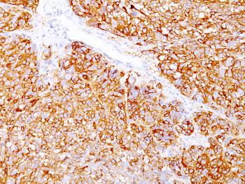 Anti-Melanoma Marker (MART-1 + gp100) Monoclonal Antibody(Clone: DT101+ BC199 + HMB45)