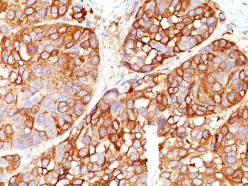 Anti-Melanoma Marker (MART-1 + Tyrosinase + gp100) Monoclonal Antibody(Clone: DT101+ BC199 + T311 + HMB45)