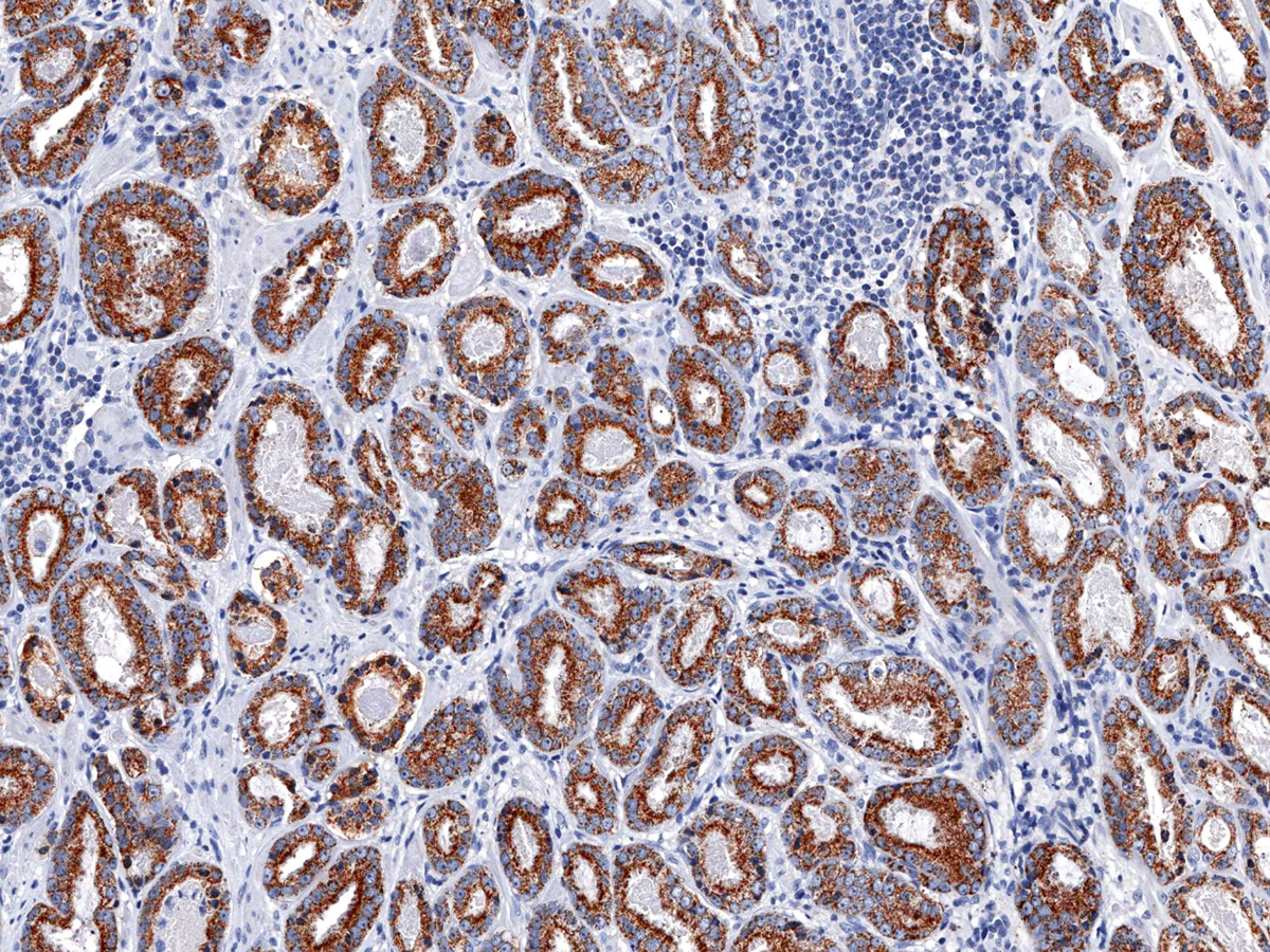 Anti-p504s Monoclonal Antibody (Clone:IHC504)-Ready to Use(Discontinued)