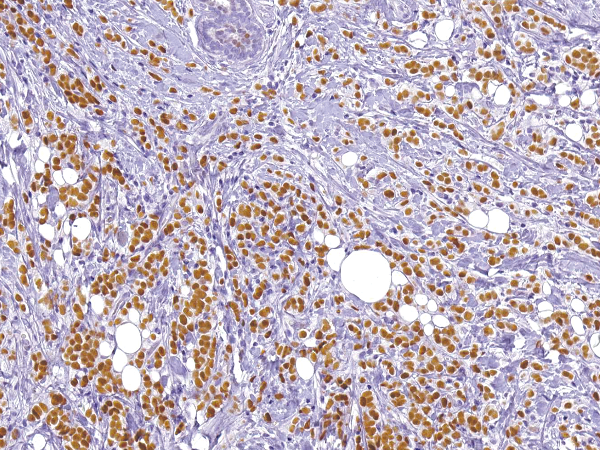 Anti-Estrogen Receptor Monoclonal Antibody (Clone:IHC403)-Ready to Use(Discontinued)